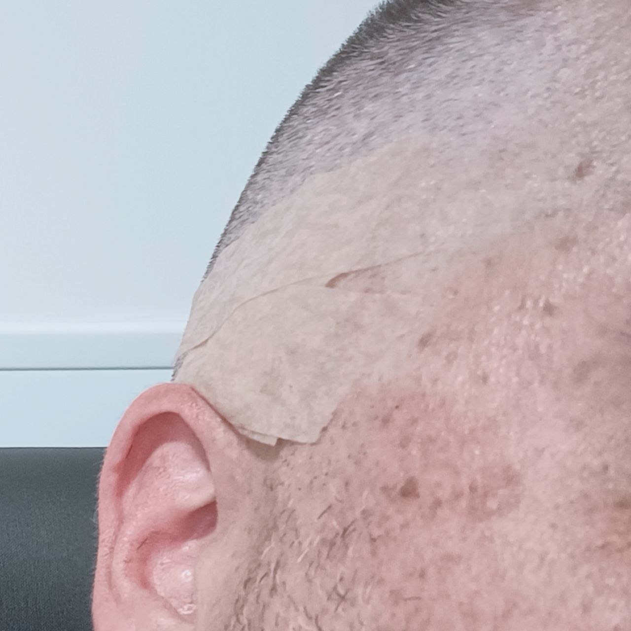 Same area with bandage covering where mole was