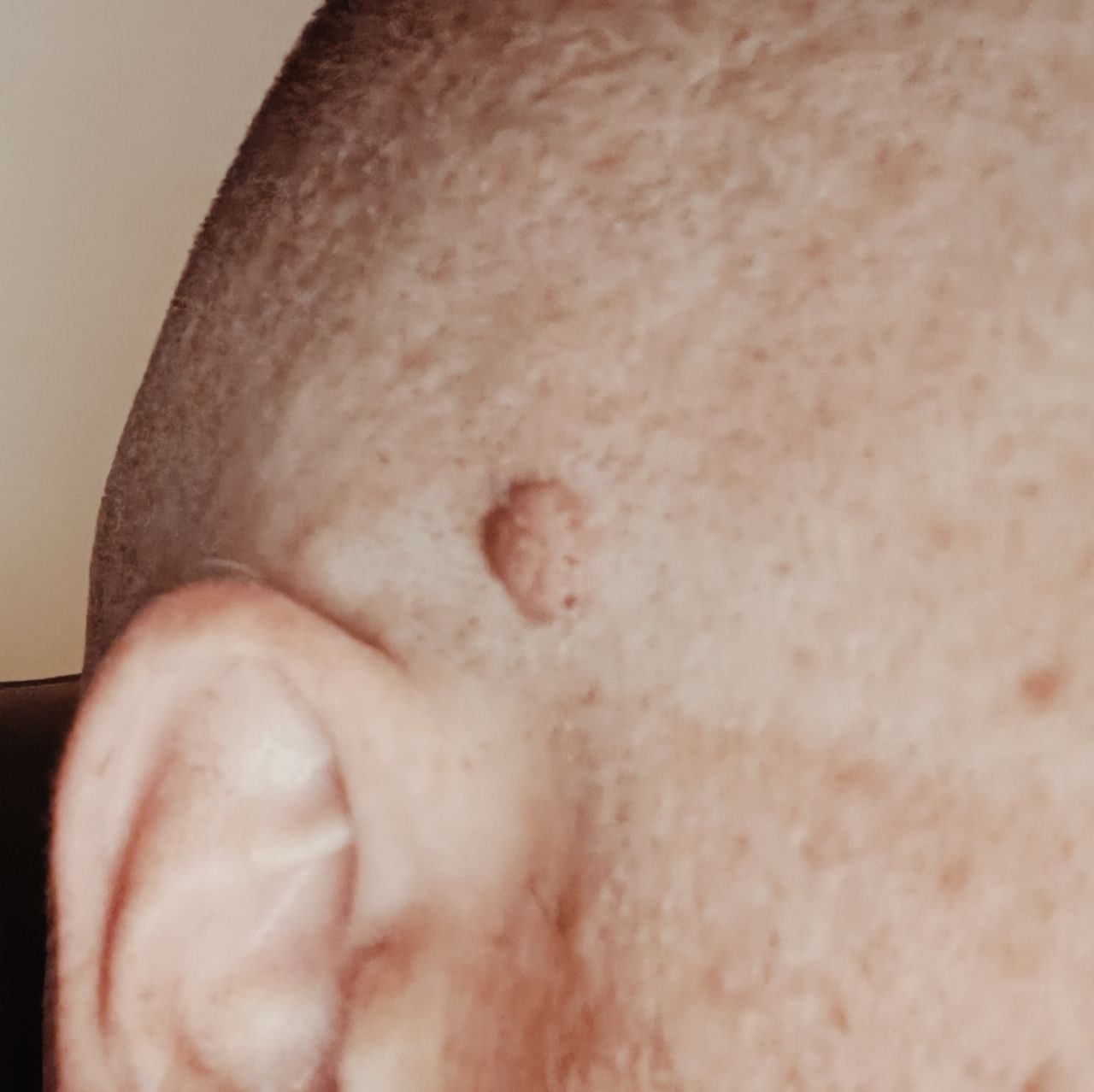 Close-up of raised mole on side of head near ear